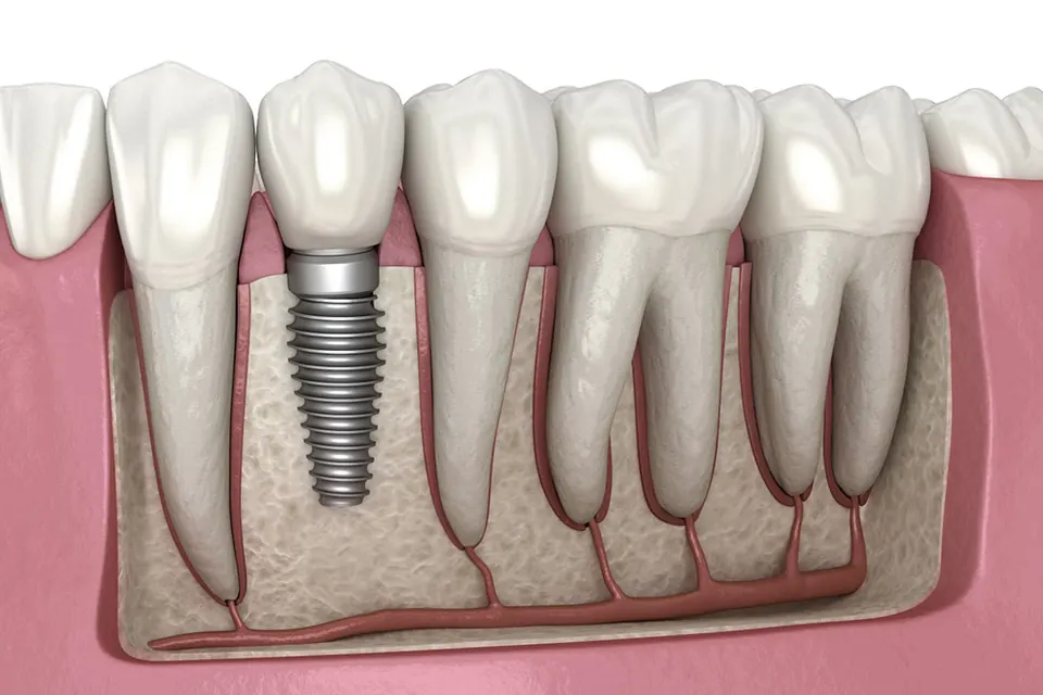 Illustration of a dental implant with abutment and crown in the jaw
