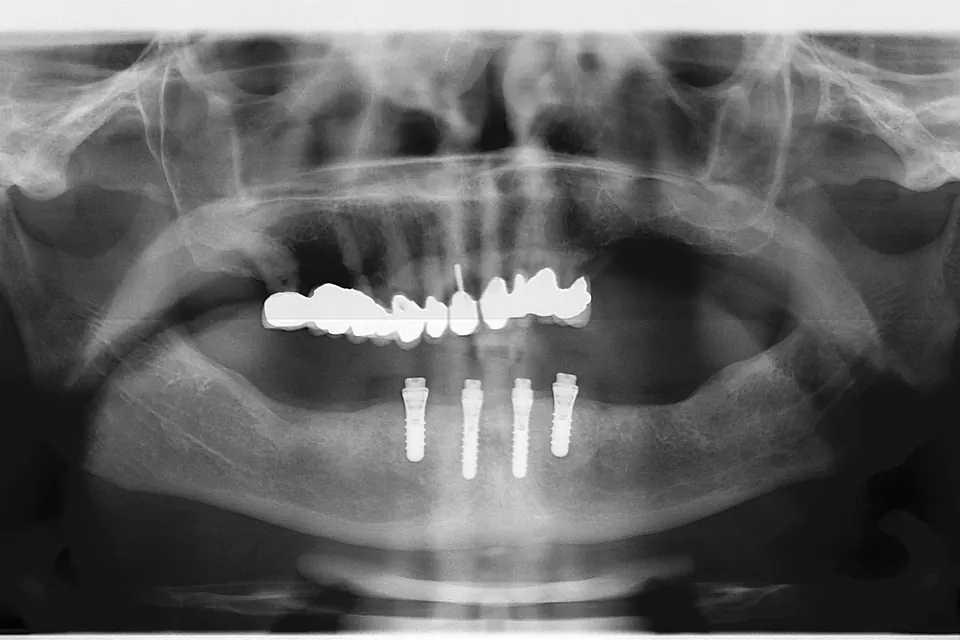 Lower jaw with implant attachments for a removable denture