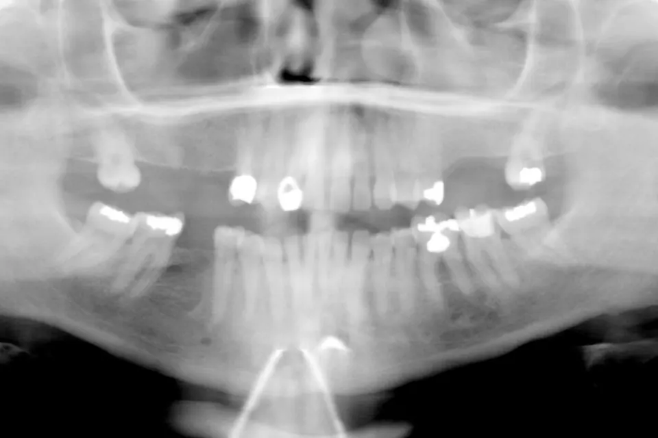 Panoramic dental X-ray showing both jaws